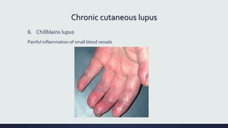 Chronic cutaneous lupus
6. Chillblains lupus
Painful inflammation of small blood vessels
 