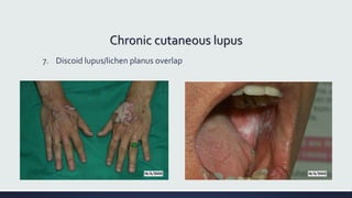 Chronic cutaneous lupus
7. Discoid lupus/lichen planus overlap
 