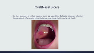Oral/Nasal ulcers
▪ In the absence of other causes, such as vasculitis, Behcet’s disease, infection
(herpesvirus), inflammatory bowel disease, reactive arthritis, and acidic foods
 
