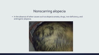 Nonscarring alopecia
▪ In the absence of other causes such as alopecia areata, drugs, iron deficiency, and
androgenic alopecia.
 