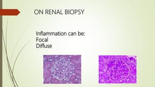 ON RENAL BIOPSY
Inflammation can be:
Focal
Diffuse
 