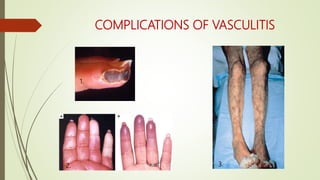 COMPLICATIONS OF VASCULITIS
1.
2. 3.
 