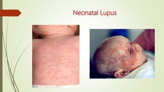 Neonatal Lupus
 