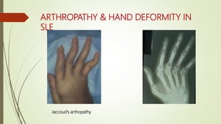 ARTHROPATHY & HAND DEFORMITY IN
SLE
Jaccoud's arthopathy
 