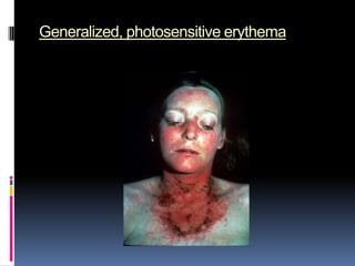 Generalized, photosensitive erythema
 