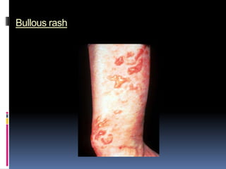 Bullous rash
 