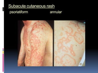 Subacute cutaneous rash
psoriatiform        annular
 