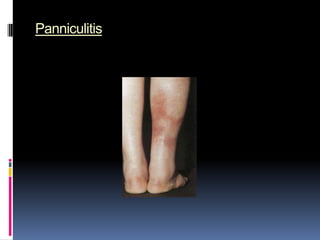 Panniculitis
 
