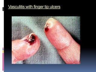 Vasculitis with finger tip ulcers
 