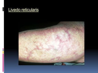 Livedo reticularis
 