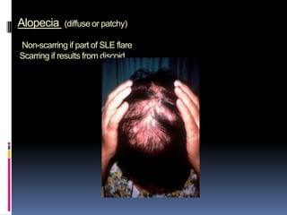 Alopecia     (diffuse or patchy)

Non-scarring if part of SLE flare
Scarring if results from discoid
 