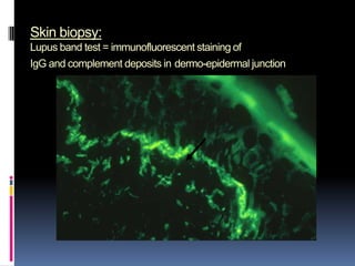 Skin biopsy:
Lupus band test = immunofluorescent staining of
IgG and complement deposits in dermo-epidermal junction
 