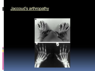 Jaccoud’s arthropathy
 
