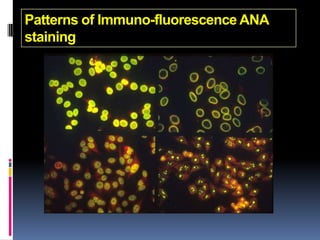 Patterns of Immuno-fluorescence ANA
staining
 