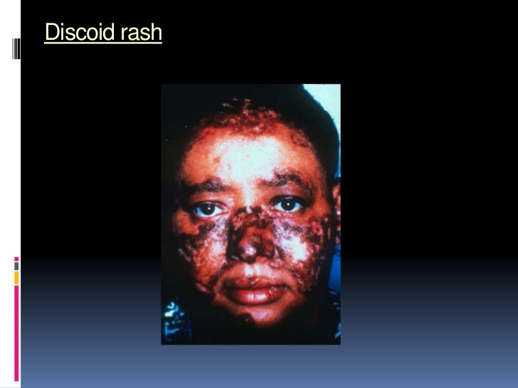 results oral sle test erythematosus overview lupus Systemic results oral sle test erythematosus overview lupus Systemic