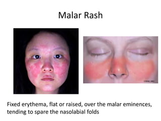Malar Rash
Fixed erythema, flat or raised, over the malar eminences,
tending to spare the nasolabial folds
 