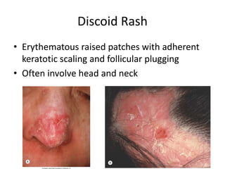 Discoid Rash
• Erythematous raised patches with adherent
keratotic scaling and follicular plugging
• Often involve head and neck
 
