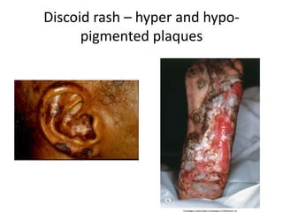 Discoid rash – hyper and hypo-
pigmented plaques
 