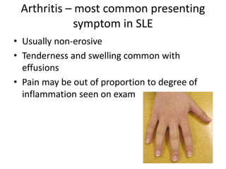Arthritis – most common presenting
symptom in SLE
• Usually non-erosive
• Tenderness and swelling common with
effusions
• Pain may be out of proportion to degree of
inflammation seen on exam
 