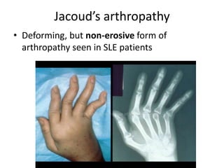 Jacoud’s arthropathy
• Deforming, but non-erosive form of
arthropathy seen in SLE patients
 