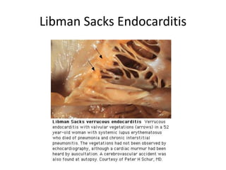 Libman Sacks Endocarditis
 