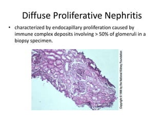 Diffuse Proliferative Nephritis
• characterized by endocapillary proliferation caused by
immune complex deposits involving > 50% of glomeruli in a
biopsy specimen.
 