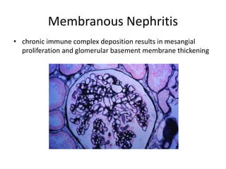 Membranous Nephritis
• chronic immune complex deposition results in mesangial
proliferation and glomerular basement membrane thickening
 