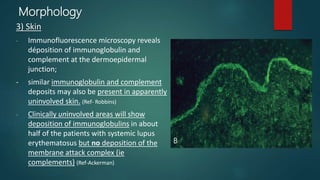 Complement Deposit Rash Systemic lupus erythematosus - Dr Pranav | PPTX