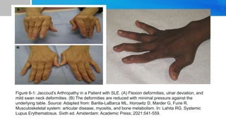 Figure 6-1: Jaccoud’s Arthropathy in a Patient with SLE. (A) Flexion deformities, ulnar deviation, and
mild swan neck deformities. (B) The deformities are reduced with minimal pressure against the
underlying table. Source: Adapted from: Barilla-LaBarca ML, Horowitz D, Marder G, Furie R.
Musculoskeletal system: articular disease, myositis, and bone metabolism. In: Lahita RG. Systemic
Lupus Erythematosus. Sixth ed. Amsterdam: Academic Press; 2021:541-559.
 