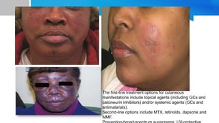 The first-line treatment options for cutaneous
manifestations include topical agents (including GCs and
calcineurin inhibitors) and/or systemic agents (GCs and
antimalarials).
Second-line options include MTX, retinoids, dapsone and
MMF.
 