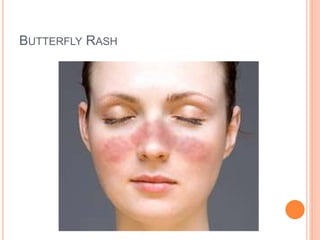 Systemic lupus erythematosus (sle) | PPTX
