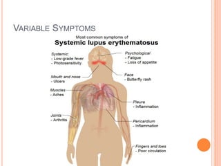 Systemic lupus erythematosus (sle) | PPTX