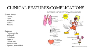Comprehensive Overview of Systemic Lupus Erythematosus (SLE ...