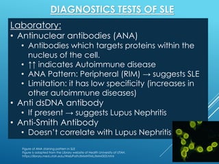 Systemic Lupus Erythematosus (SLE) | PDF