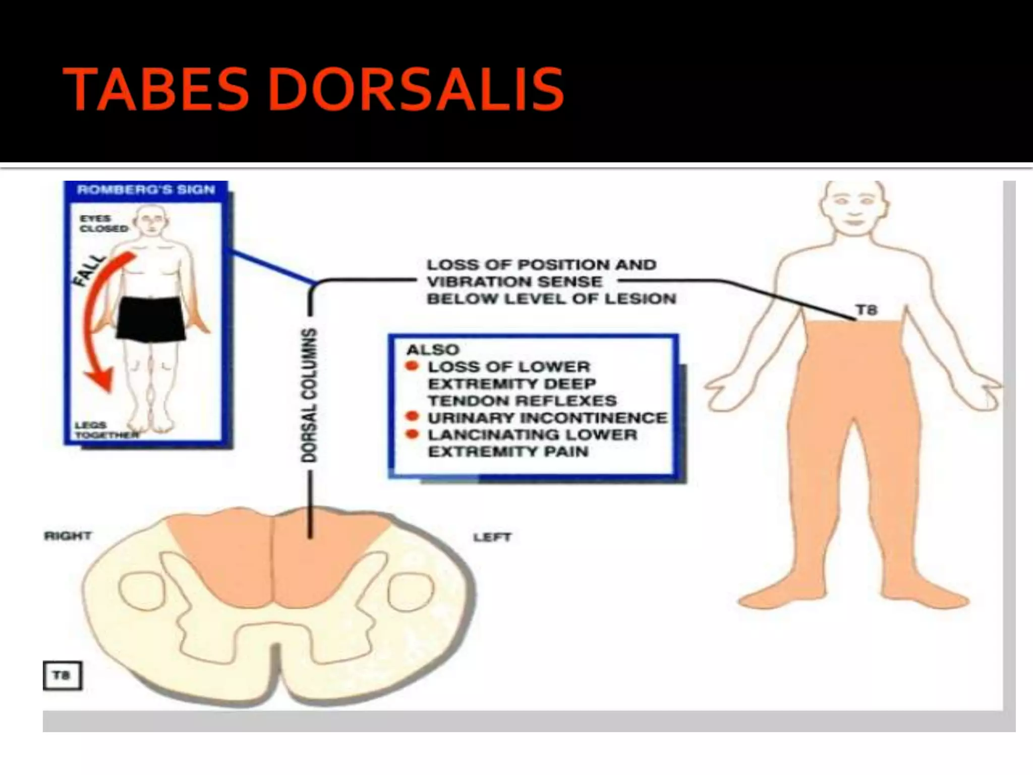  Late manifestation of untreated tertiary
syphilis.
 Locomotor ataxia
 There is slow degeneration of myelinated
sensory nerve fibres specially present in
dorsal column of the spinal cord
 