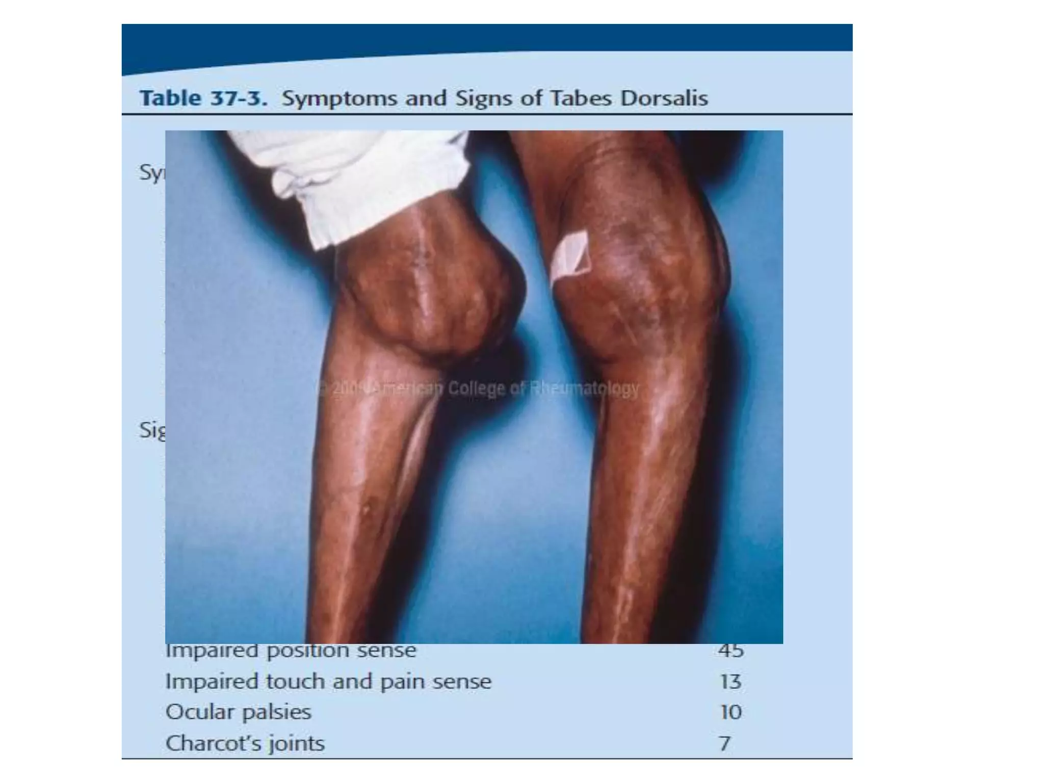 Lightning pains
Bladder
disturbances
Sensory ataxia
 