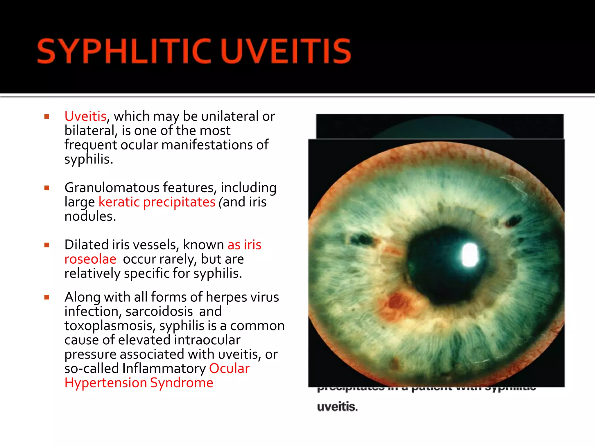  Uveitis, which may be unilateral or
bilateral, is one of the most
frequent ocular manifestations of
syphilis.
 Granulomatous features, including
large keratic precipitates (and iris
nodules.
 Dilated iris vessels, known as iris
roseolae occur rarely, but are
relatively specific for syphilis.
 Along with all forms of herpes virus
infection, sarcoidosis and
toxoplasmosis, syphilis is a common
cause of elevated intraocular
pressure associated with uveitis, or
so-called Inflammatory Ocular
Hypertension Syndrome
 