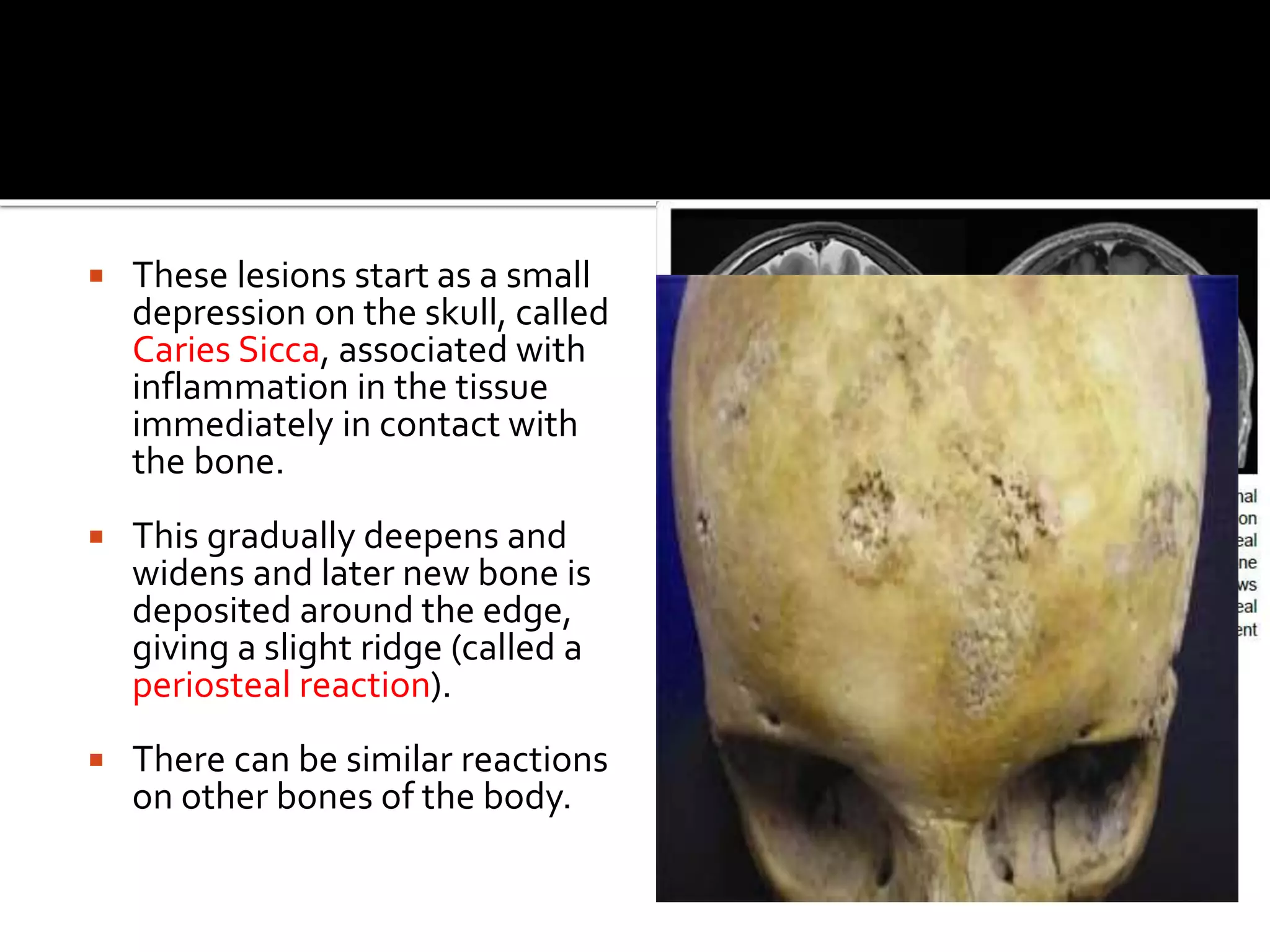  These lesions start as a small
depression on the skull, called
Caries Sicca, associated with
inflammation in the tissue
immediately in contact with
the bone.
 This gradually deepens and
widens and later new bone is
deposited around the edge,
giving a slight ridge (called a
periosteal reaction).
 There can be similar reactions
on other bones of the body.
 