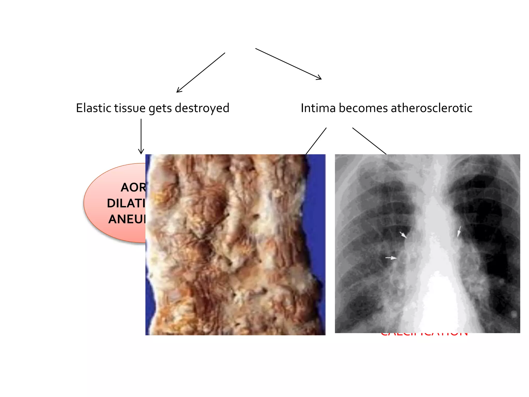 Elastic tissue gets destroyed
AORTIC
DILATION &
ANEURYSM
Intima becomes atherosclerotic
Extensive plaque
formation
TREE BARK
APPEARENCE
Calcification of the intima
EGG SHELL
CALCIFICATION
 
