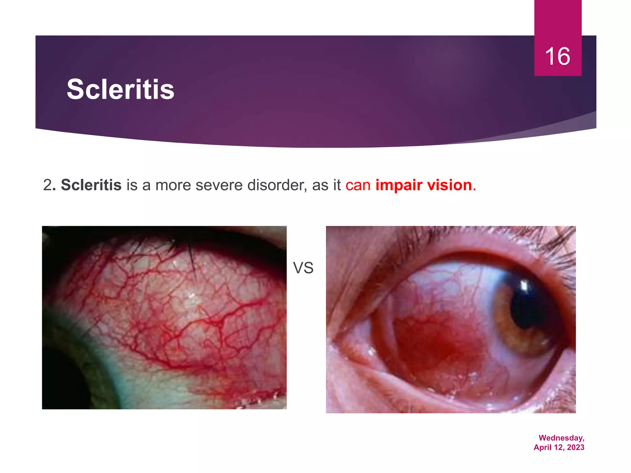 Wednesday,
April 12, 2023
16
Scleritis
2. Scleritis is a more severe disorder, as it can impair vision.
VS
 