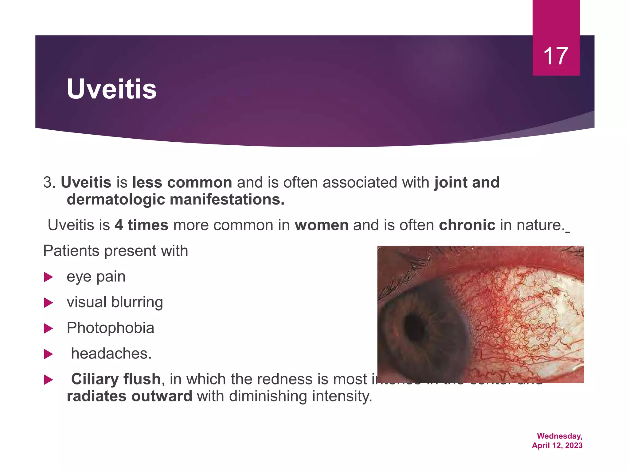 Wednesday,
April 12, 2023
17
Uveitis
3. Uveitis is less common and is often associated with joint and
dermatologic manifestations.
Uveitis is 4 times more common in women and is often chronic in nature.
Patients present with
 eye pain
 visual blurring
 Photophobia
 headaches.
 Ciliary flush, in which the redness is most intense in the center and
radiates outward with diminishing intensity.
 