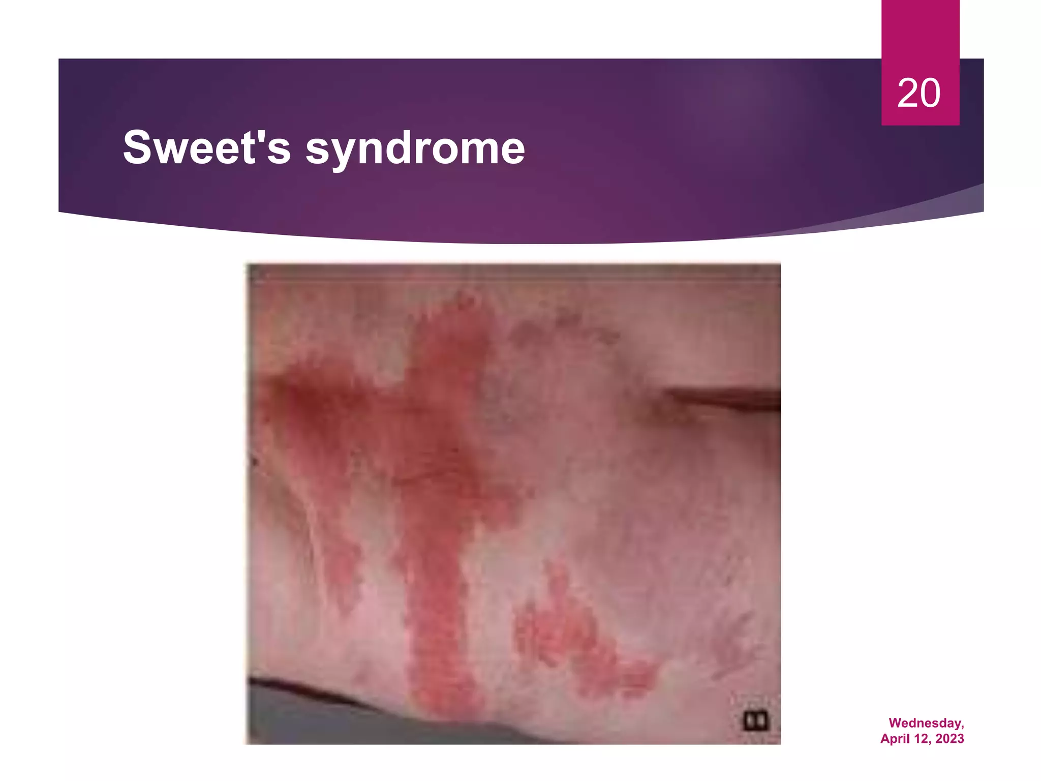 Wednesday,
April 12, 2023
20
Sweet's syndrome
 