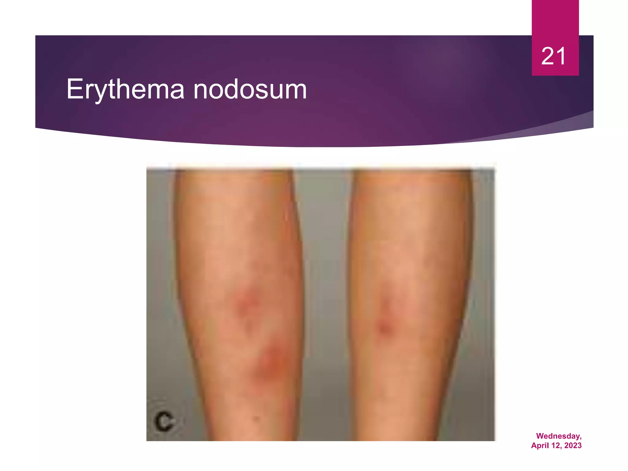 Wednesday,
April 12, 2023
21
Erythema nodosum
 