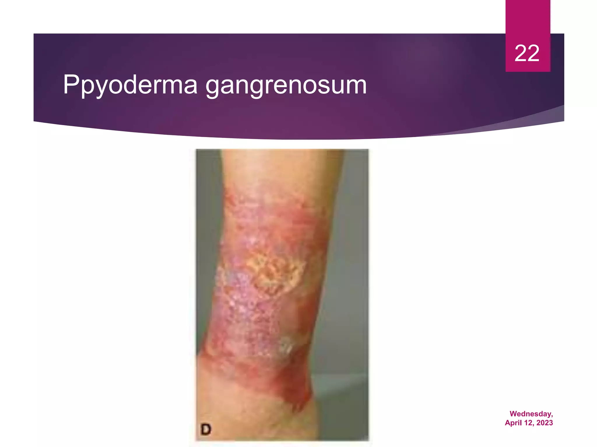 Wednesday,
April 12, 2023
22
Ppyoderma gangrenosum
 
