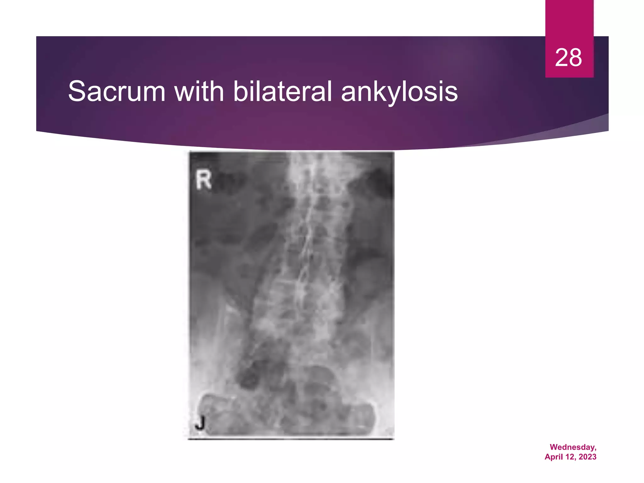 Wednesday,
April 12, 2023
28
Sacrum with bilateral ankylosis
 