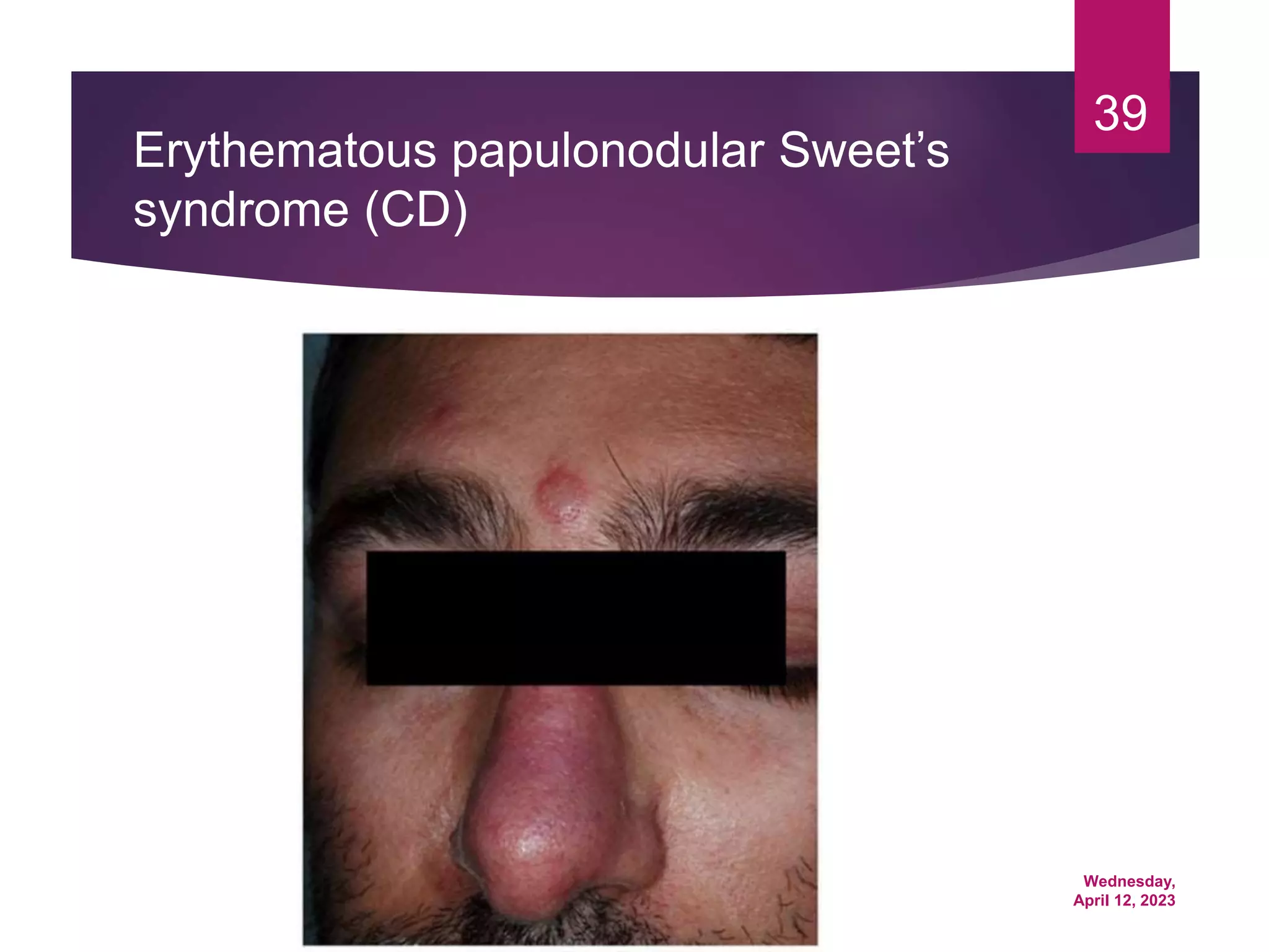 Wednesday,
April 12, 2023
39
Erythematous papulonodular Sweet’s
syndrome (CD)
 