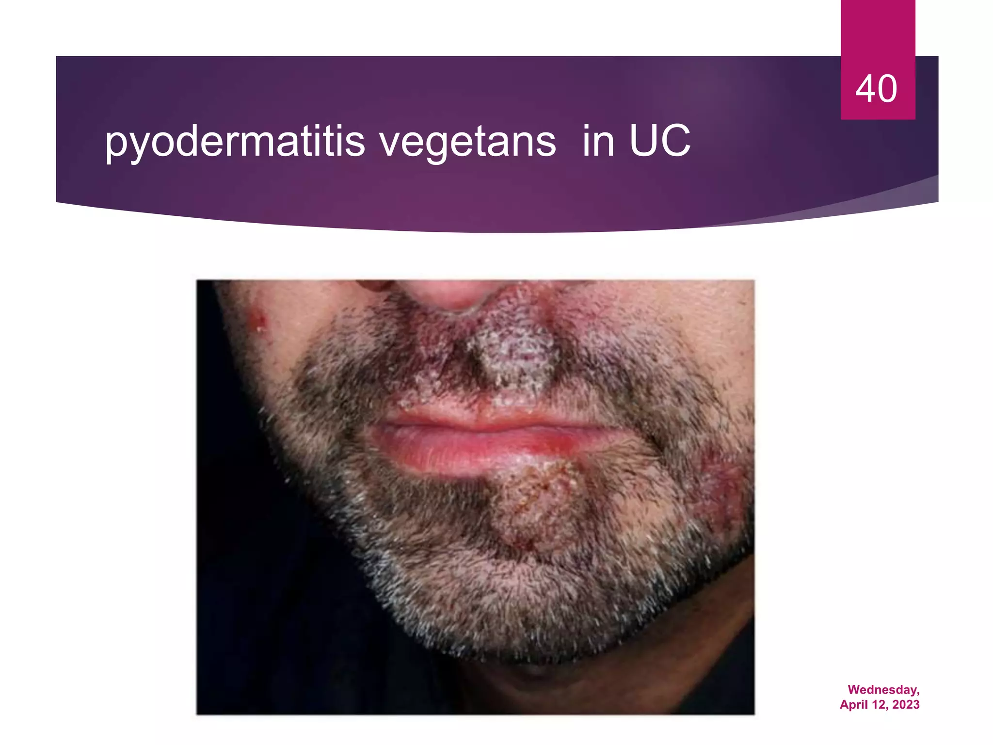 Wednesday,
April 12, 2023
40
pyodermatitis vegetans in UC
 