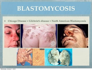 BLASTOMYCOSIS
             Chicago Disease = Gilchrist’s disease = North American Blastomycosis




Wednesday, January 11, 2012
 