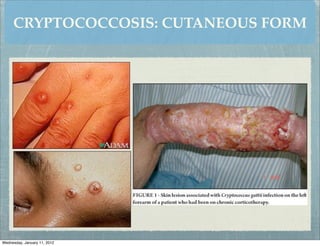 CRYPTOCOCCOSIS: CUTANEOUS FORM




Wednesday, January 11, 2012
 