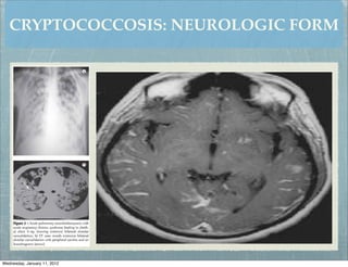 CRYPTOCOCCOSIS: NEUROLOGIC FORM




Wednesday, January 11, 2012
 